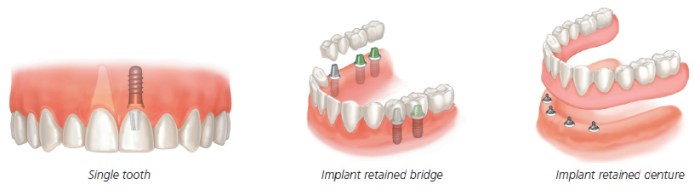 Dental Implants Scenarios at Divine Dental Clinic